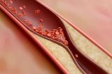 Notre sang est saturé de microplastiques : voici ce que ça signifie