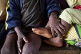 Variole du singe : 581 morts de mpox depuis janvier, nombre de cas record sur une année